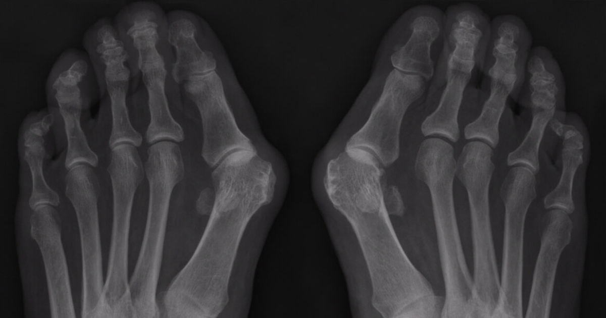 Hallux Valgus oorzaken en behandeling | IEDEREEN LOOPT