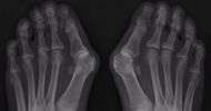 Hallux Valgus oorzaken en behandeling | IEDEREEN LOOPT